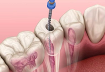 Điều Trị Tủy Răng