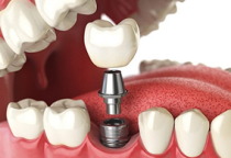 Trồng Răng Implant
