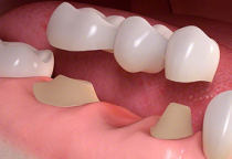Răng Sứ Thẩm Mỹ - Dán Sứ