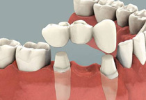 Trồng Răng & Tháo Lắp