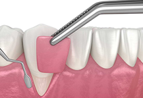 Phẩu Thuật Nha Chu