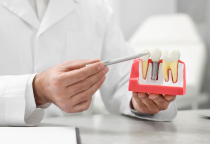 Trồng Răng Implant Có Đau Không? Giải Đáp Từ Chuyên Gia Nha Khoa