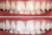 Có Nên Tẩy Trắng Răng Không? Những Điều Cần Biết Trước Khi Thực Hiện