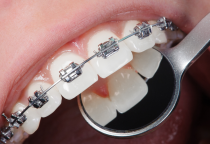 Niềng Răng Bao Lâu Có Kết Quả? Những Điều Cần Biết Trước Khi Niềng