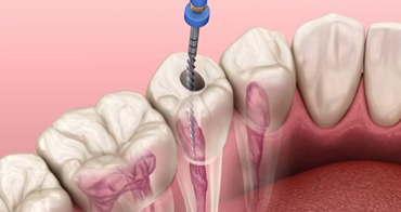 Điều Trị Tủy Răng