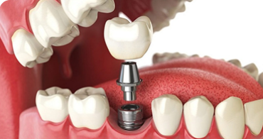 Trồng Răng Implant