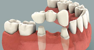 Trồng Răng & Tháo Lắp