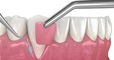 Phẩu Thuật Nha Chu