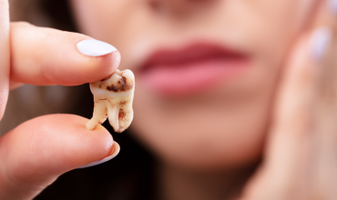 Cách Phòng Ngừa Sâu Răng Hiệu Quả – Bí Quyết Giữ Gìn Nụ Cười Khỏe Mạnh