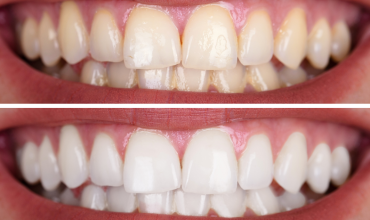 Có Nên Tẩy Trắng Răng Không? Những Điều Cần Biết Trước Khi Thực Hiện
