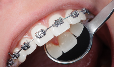 Niềng Răng Bao Lâu Có Kết Quả? Những Điều Cần Biết Trước Khi Niềng